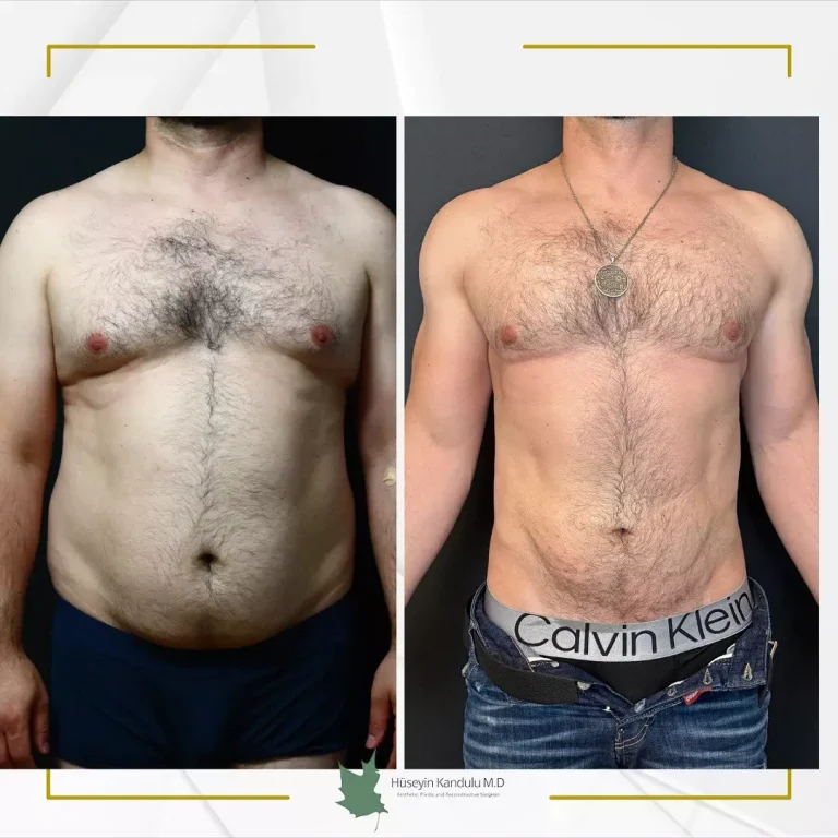 Liposuction in Dubai